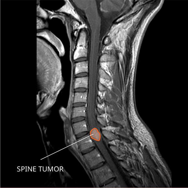 Ependymoma 1
