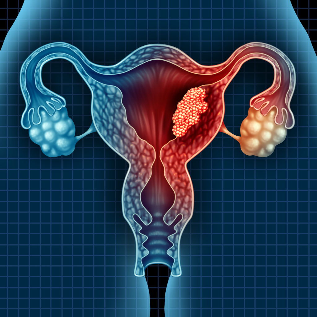 Endometrial carcinoma