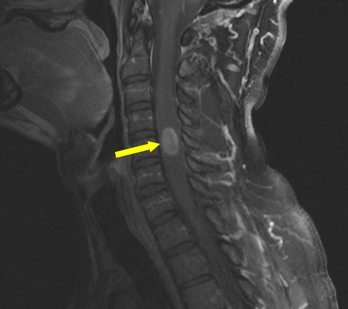 Ependymoma 2